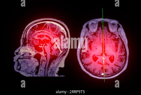 RM scansione cerebrale Vista assiale e sagittale con linea di riferimento per rilevare le malattie cerebrali sush come ictus malattia, tumori cerebrali e infezioni. Foto Stock