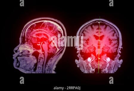 RM scansione cerebrale Vista sagittale e coronale con linea di riferimento per rilevare le malattie cerebrali sush come ictus malattia, tumori cerebrali e infezioni. Foto Stock