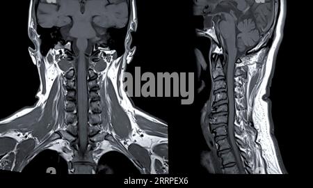 RM della colonna cervicale o risonanza magnetica della colonna cervicale Vista coronale e sagittale per diagnosi spondilosi e frattura da compressione. Foto Stock