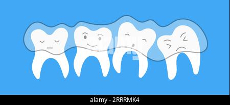 Denti piatti e scuri con allineatori trasparenti. Trattamento ortodontico dentale. Concetto di igiene orale per bambini per odontoiatria pediatrica. Pulizia dei denti Illustrazione Vettoriale
