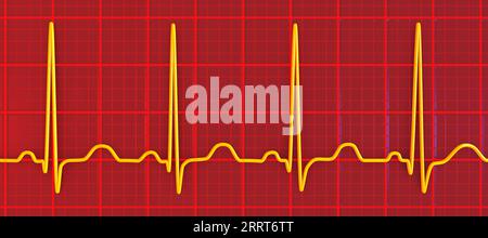 Tachicardia sinusale ritmo cardiaco, illustrazione Foto Stock