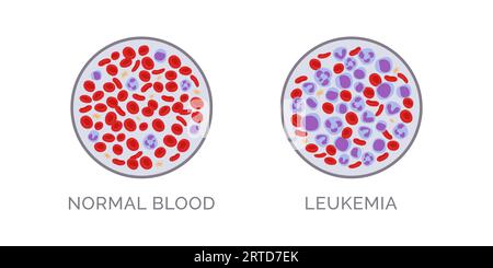 Confronto degli esami del sangue: Normale e leucemia, concetto di diagnosi del cancro del sangue Illustrazione Vettoriale