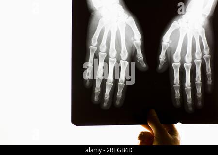 La mano di un operatore sanitario tenendo premuto x-ray di una coppia le mani Foto Stock