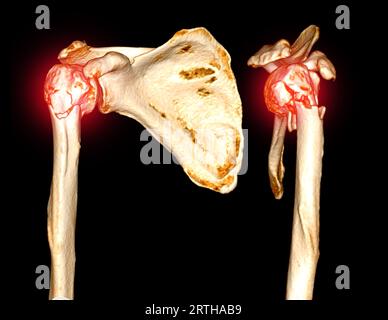 Scansione TC rendering 3D dell'articolazione della spalla che mostra la frattura della testa dell'omero . Foto Stock