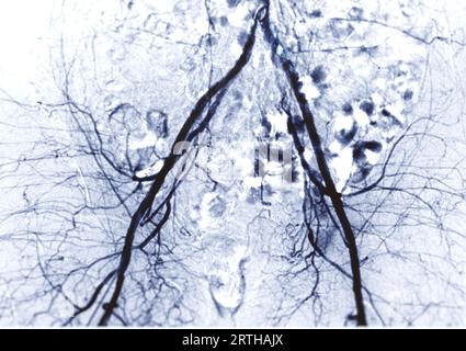 Angiogramma o angiografia dell'arteria femorale Foto Stock