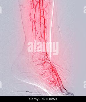 Angiogramma plantare o angiogramma plantare che mostra arteria plantare e tarsale nell'area del piede. Foto Stock