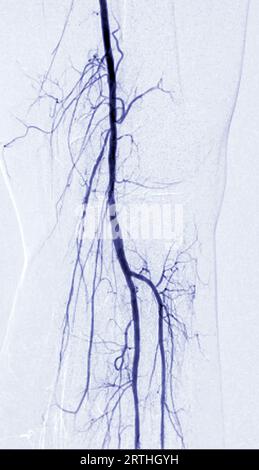 Angiografia o angiografia dell'arteria femorale nell'area del ginocchio. Foto Stock