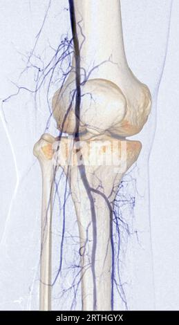 Angiografia o angiografia dell'arteria femorale nell'area del ginocchio. Foto Stock