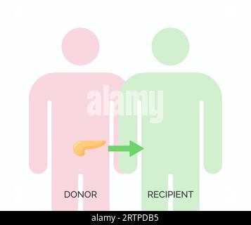 Concetto di trapianto di organi umani. Illustrazione vettoriale del donatore e del ricevente dell'organo pancreatico Illustrazione Vettoriale