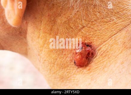 Un grande polipo , una verruca , una talpa sul collo di un uomo . papilloma mole sulla pelle umana, macro shot, concetto di salute, cura della pelle e rischio di cancro. Foto Stock