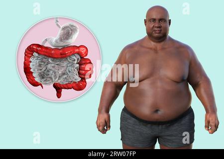 Sindrome dell'intestino irritabile, illustrazione Foto Stock