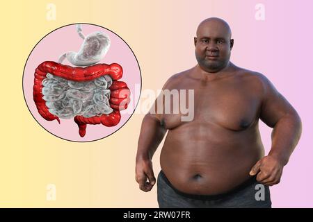 Sindrome dell'intestino irritabile, illustrazione Foto Stock