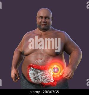 Sindrome dell'intestino irritabile, illustrazione Foto Stock