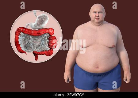 Sindrome dell'intestino irritabile, illustrazione Foto Stock