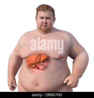 Uomo in sovrappeso con steatosi epatica, illustrazione Foto Stock
