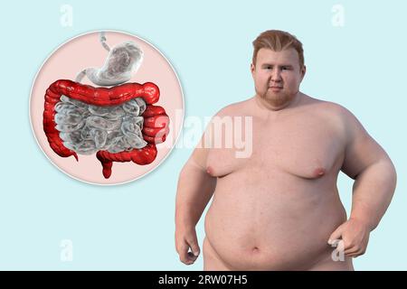 Sindrome dell'intestino irritabile, illustrazione Foto Stock