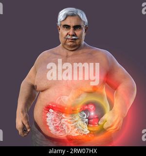 Sindrome dell'intestino irritabile, illustrazione Foto Stock