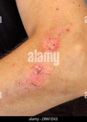 Pelle femminile con cicatrice. Primo piano delle cicatrici di un incidente d'auto Foto Stock