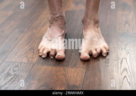 I martelli deformati dell'uomo mostrano il piede sinistro un anno dopo l'intervento Foto Stock