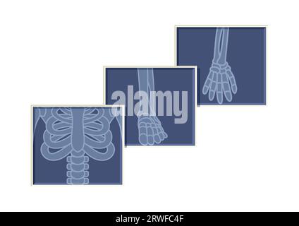 Struttura piatta del vettore radiologico radiologico radiologico a raggi X su sfondo bianco per ossa scheletriche di torace, braccia e piedi Illustrazione Vettoriale