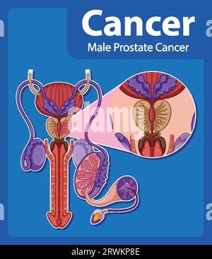 Infografica che illustra la crescita anormale delle cellule nel cancro della prostata maschile Illustrazione Vettoriale