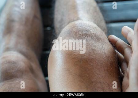 distorsione legamentosa, lussazione della ginocchia, lesione dovuta all'impatto diretto di un oggetto duro durante lo sport sepak takraw, che causa dolore e lividi Foto Stock