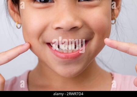 Primo piano di una ragazza simpatica che sorride in grande, mostrando uno spazio vuoto con i primi denti anteriori in crescita. Ragazzina con un grande sorriso e senza denti di latte. Denta Foto Stock