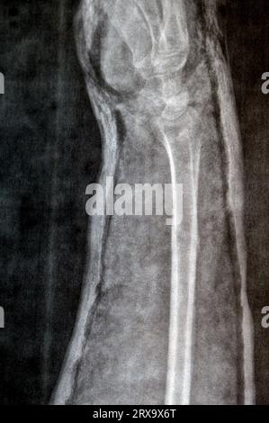 Radiografia semplice dell'avambraccio destro (erroneamente scritta a sinistra sul film) che mostra fratture della parte inferiore dell'ulna in cast per 4 settimane e ha iniziato a guarire Foto Stock