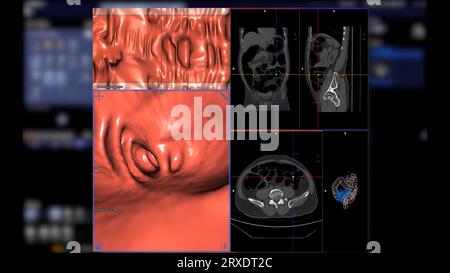 la colonografia TC confronta il piano assiale, sagittale, coronale 2D e l'immagine di rendering 3D per lo screening del cancro del colon-retto. Per i controlli annuali dello stato di salute da controllare Foto Stock