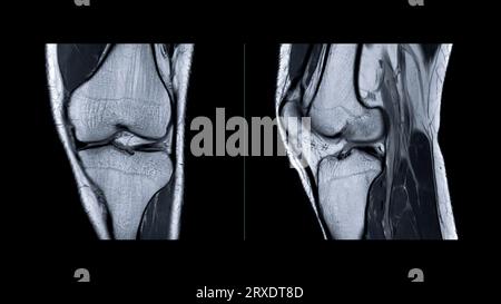 Risonanza magnetica dell'articolazione del ginocchio o sagittale del ginocchio RM per rilevare lacerazioni o distorsione del legamento crociato anteriore (LCA). Foto Stock