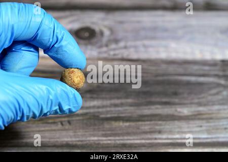 Calcoli biliari grandi rimossi chirurgicamente dopo colecistectomia laparoscopica, calcoli biliari sono depositi induriti di liquido digestivo che possono formarsi in colecisti Foto Stock