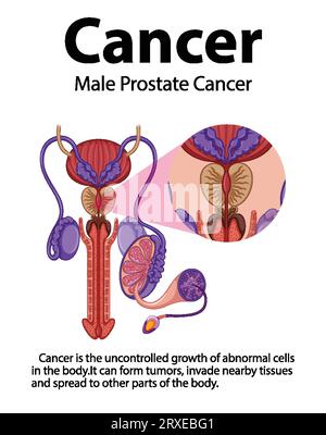 Infografica che illustra le differenze tra cellule prostatiche normali e cancerose Illustrazione Vettoriale