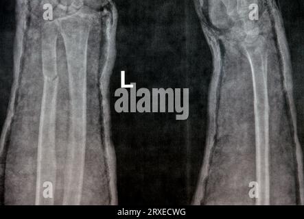 Radiografia semplice dell'avambraccio destro (erroneamente scritta a sinistra sul film) che mostra fratture della parte inferiore dell'ulna in cast per 4 settimane e ha iniziato a guarire Foto Stock