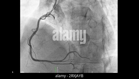 Il cateterismo cardiaco sull'arteria coronaria destra (RCA) può aiutare il medico a diagnosticare e trattare i problemi del cuore e dei vasi sanguigni come un cuore AT Foto Stock