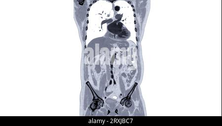 TC torace e addome con mezzo di contrasto per iniezione vista coronale per diagnosi dolore toracico e addominale. Foto Stock