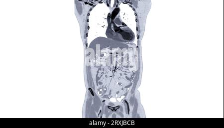 TC torace e addome con mezzo di contrasto per iniezione vista coronale per diagnosi dolore toracico e addominale. Foto Stock