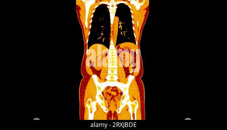 TC torace e addome con mezzo di contrasto per iniezione vista coronale per diagnosi dolore toracico e addominale. Foto Stock