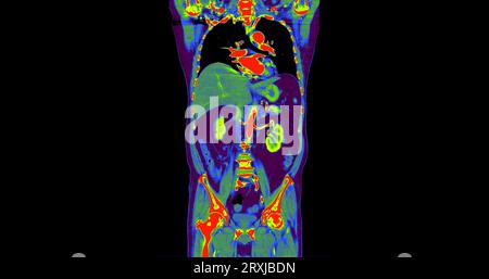 TC torace e addome con mezzo di contrasto per iniezione vista coronale per diagnosi dolore toracico e addominale. Foto Stock
