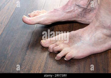 I martelli deformati dell'uomo mostrano il piede sinistro un anno dopo l'intervento Foto Stock