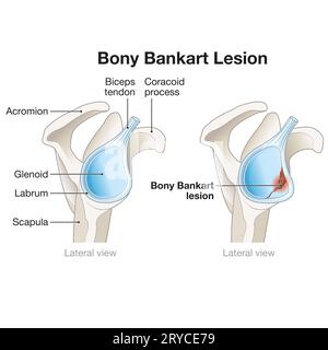 Una lesione ossea di Bankart nella spalla comporta una frattura del bordo glenoide anteriore, spesso derivante da lussazione, che porta a instabilità e re Foto Stock