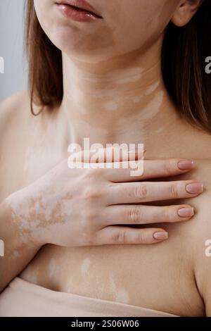 Foto ritagliata verticale di una giovane donna con vitiligine che riposa la mano sul petto, abbracciando la bellezza naturale di una pelle unica mentre posa elegantemente in studio Foto Stock