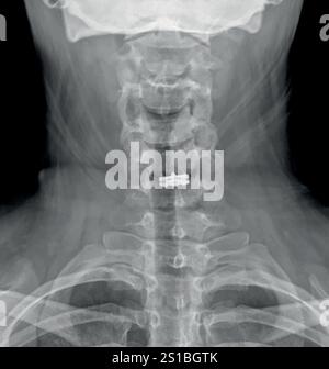 Radiografia del collo di un paziente sottoposto a Microdiscectomia cervicale e protesi cervicale del disco per la ricerca medica e l'insegnamento. Illustrazione vettoriale. Illustrazione Vettoriale