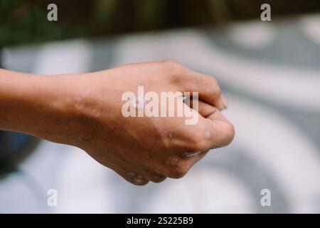 Primo piano di una cicatrice guarita sulla mano destra, che mostra pelle secca Foto Stock