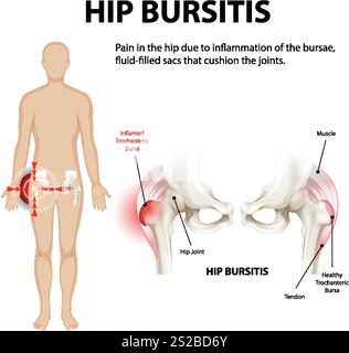Illustrazione di borsite dell'anca e infiammazione articolare Illustrazione Vettoriale