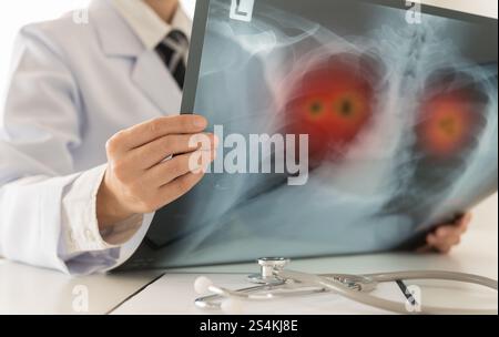 Cancro ai polmoni. Esame radiologico medico l'immagine a raggi x presenta un tumore polmonare problematico del paziente nella sala clinica. Foto Stock