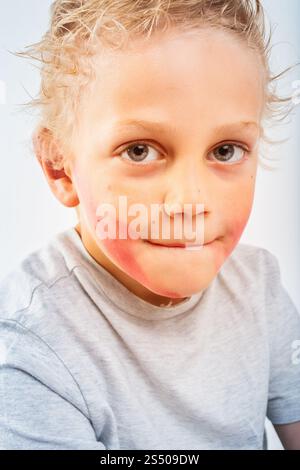 Primo piano ritratto di un bambino biondo con guance rosse arrossate e mento, che mostra segni di una reazione allergica al cibo o una condizione della pelle, evidenziando d Foto Stock