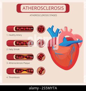 Stadi di aterosclerosi. Ictus cardiaci attacco trombo sangue sistema circolatorio vettoriale infografica medica. Illustrazione dell'arteria del colesterolo, del cuore umano e del sistema cardiovascolare. Stadi di aterosclerosi. Ictus cardiaci attacco trombo sangue sistema circolatorio vettoriale infografica medica Illustrazione Vettoriale