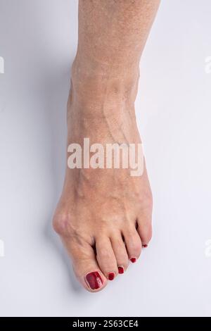 Vista ravvicinata del piede di una donna con un evidente problema di bunion Foto Stock