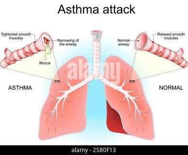 Attacco d'asma. Polmoni, bronchi e vie aeree. Primo piano di una sezione trasversale di una normale via aerea e ristretto di bronchioli con muco. Sintomi di asma Illustrazione Vettoriale