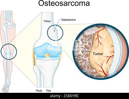 Osteosarcoma. Tumore maligno dell'osso. Gamba umana con cancro osseo. Primo piano di un'articolazione del ginocchio e di un tessuto osseo con tumore. Illustrazione vettoriale. Posto medico Illustrazione Vettoriale